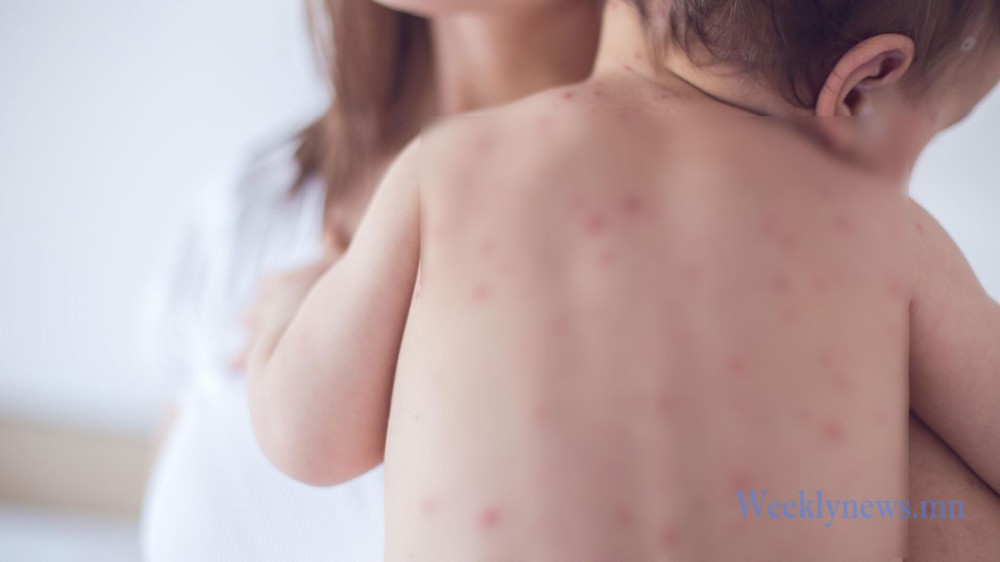 УЛААНБУРХАН ӨВЧИН УЛААНБААТАР, ӨМНӨГОВЬ, ДУНДГОВЬ АЙМАГТ ГОЛОМТЛОН ГАРЧ БАЙНА