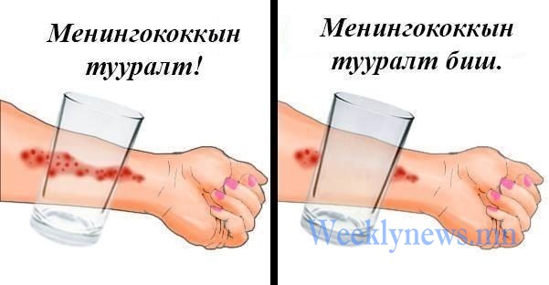 МЕНИНГОККОКТ ХАЛДВАРААР ӨВЧИЛСӨН 5 НАСТАЙ ХҮҮ НАС БАРЖЭЭ