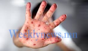 ХӨСҮТ: УЛААНБУРХАН ӨВЧНИЙ 85 ДАХ ТОХИОЛДОЛ БҮРТГЭГДЛЭЭ