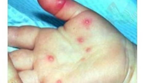 ХӨСҮТ: УЛААНБУРХАН ӨВЧНИЙ ХАЛДВАР 93 ХҮРЛЭЭ