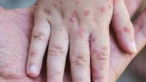 УЛААНБУРХАН ӨВЧНИЙ 11 ДЭХ ТОХИОЛДОЛ БАТЛАГДЛАА