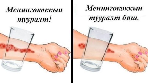 МЕНИНГОККОКТ ХАЛДВАРААР ӨВЧИЛСӨН 5 НАСТАЙ ХҮҮ НАС БАРЖЭЭ