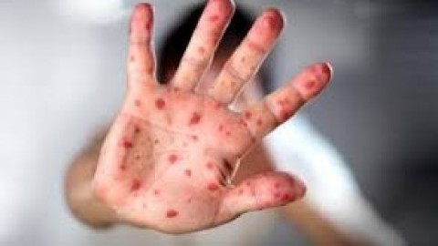 ХӨСҮТ: УЛААНБУРХАН ӨВЧНИЙ 85 ДАХ ТОХИОЛДОЛ БҮРТГЭГДЛЭЭ